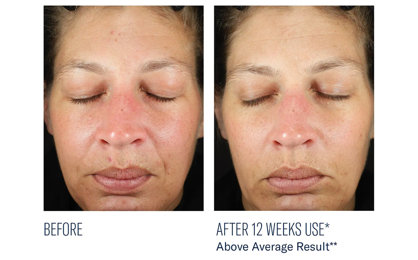 BioRewind Skin Health Dietary Supplement The Piazza Center for Plastic Surgery & Advanced Skincare