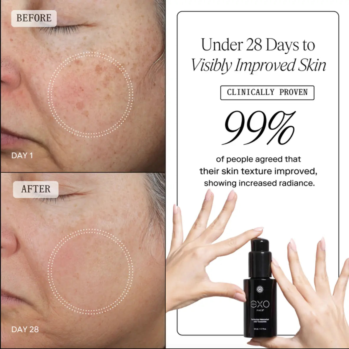 Before and After Pigmentation Results from Exo Face. 99% satisfaction