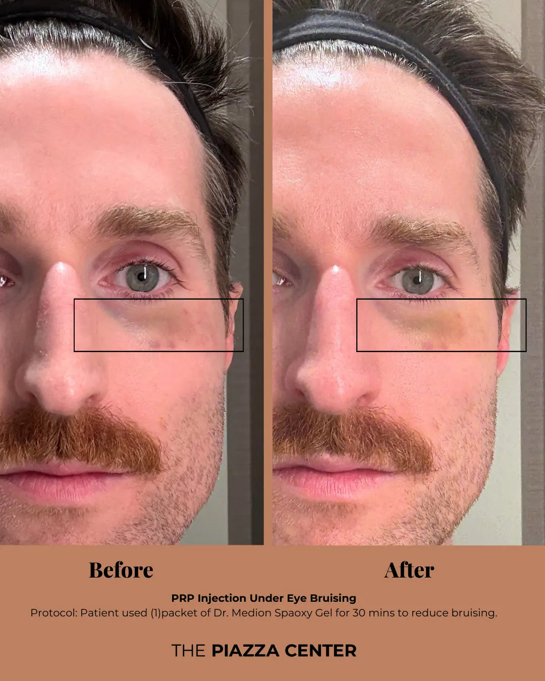 Patient Before and After after Dr. Medion Spaoxy Gel for Bruising