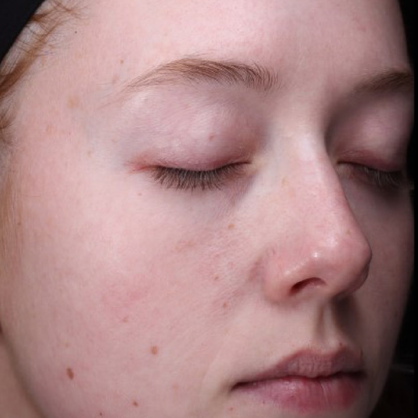 After using Revision Radiance+ Resurfacing Serum — clinical photography supplied by Revision Skincare. Individual results may vary.