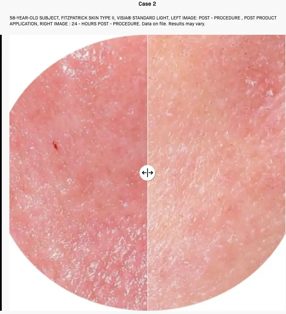 Revision Procedure Prep & Recover Regimen - Trial Size The Piazza Center for Advanced Skincare