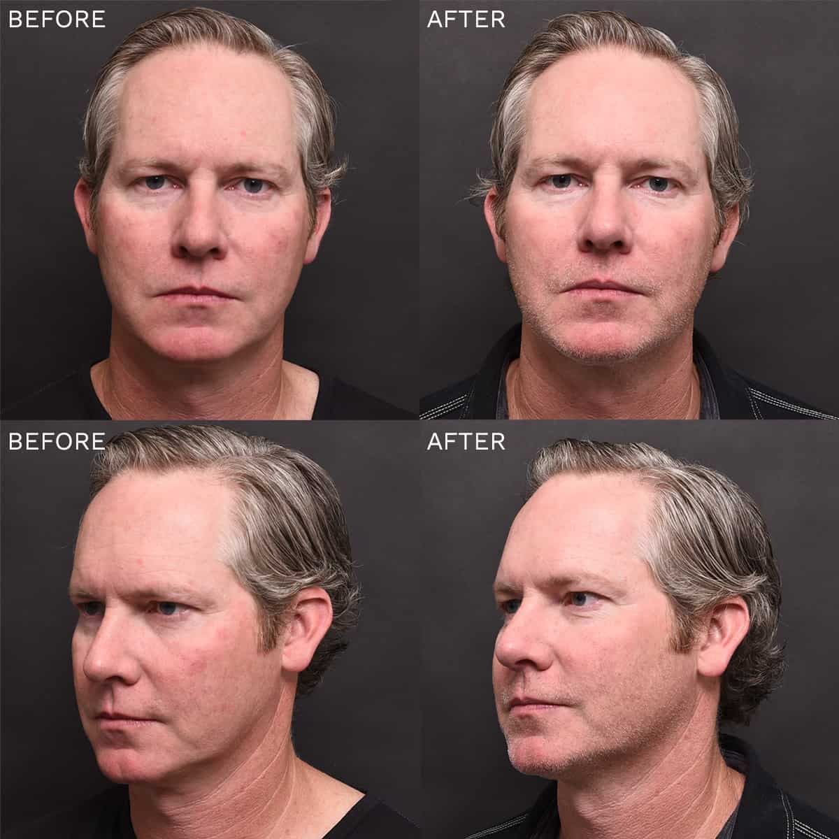 Damage Control "One and Done" The Piazza Center for Advanced Skincare