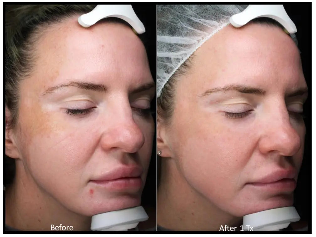 Melasma Treatment: CO2 Mask Results
