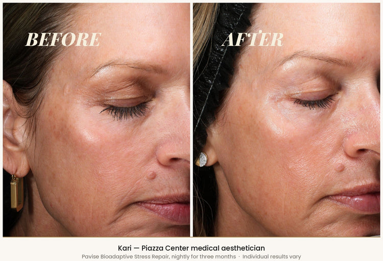 Kari, Piazza Center medical aesthetician, before and after three months of nightly Pavise Bioadaptive Stress Repair — reduced cheek pigmentation. Individual results vary.