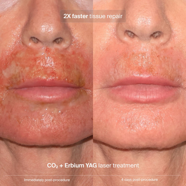 Pavise clinical data: 2X faster tissue repair after CO2 and Erbium YAG laser treatment