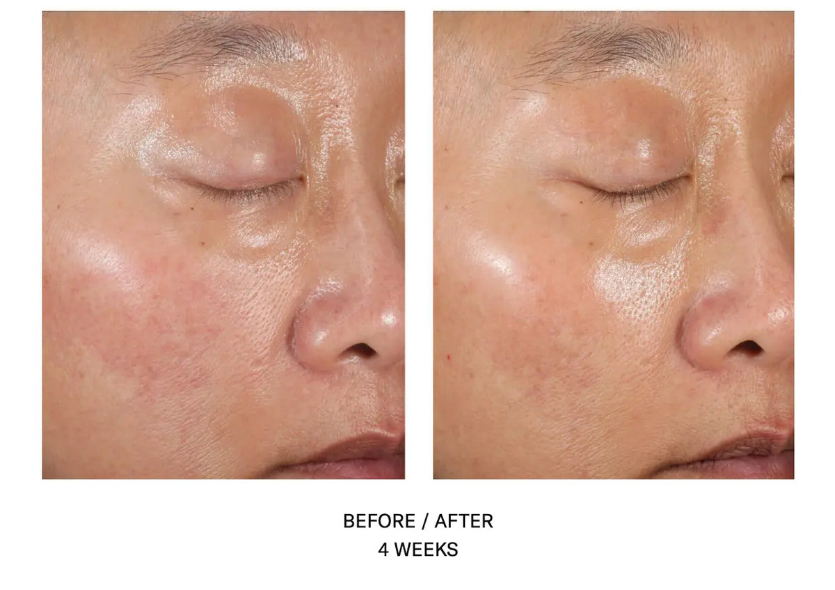 Before and After - A-Team Skinbetter