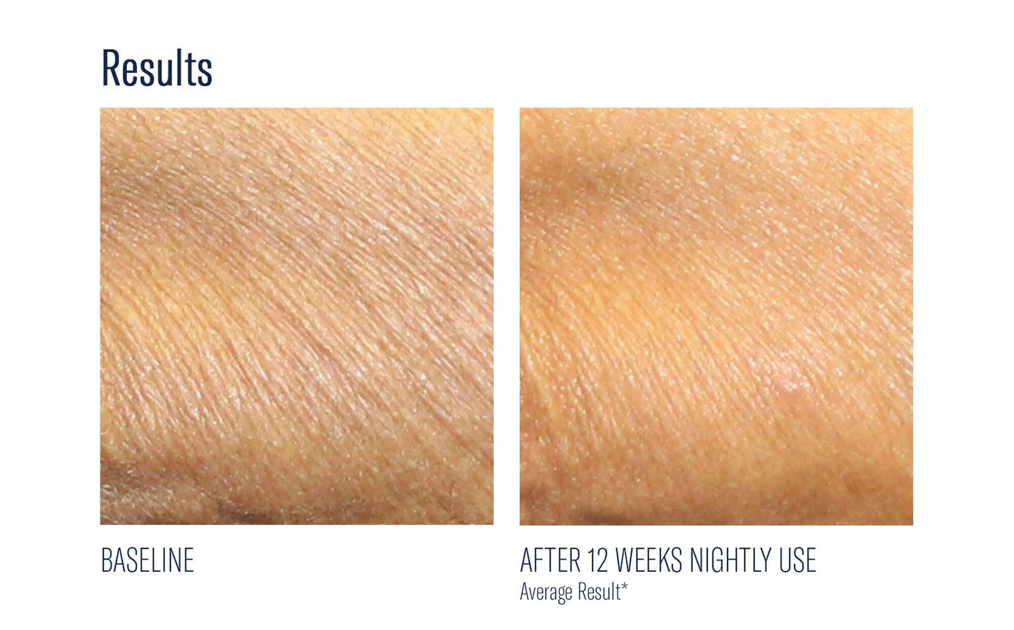 skinbetter alpharet body before & after 1