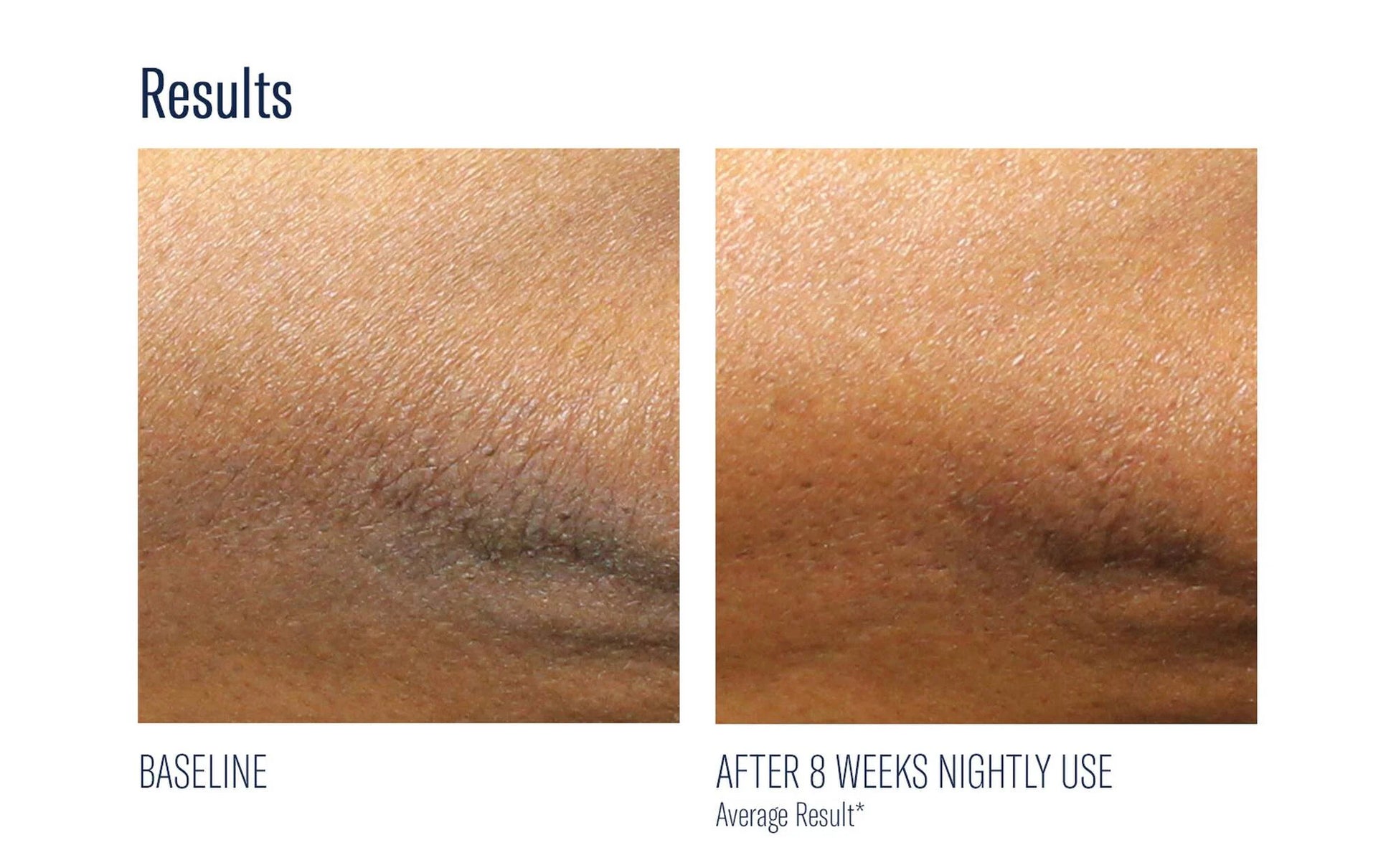 skinbetter alpharet body before & after 2