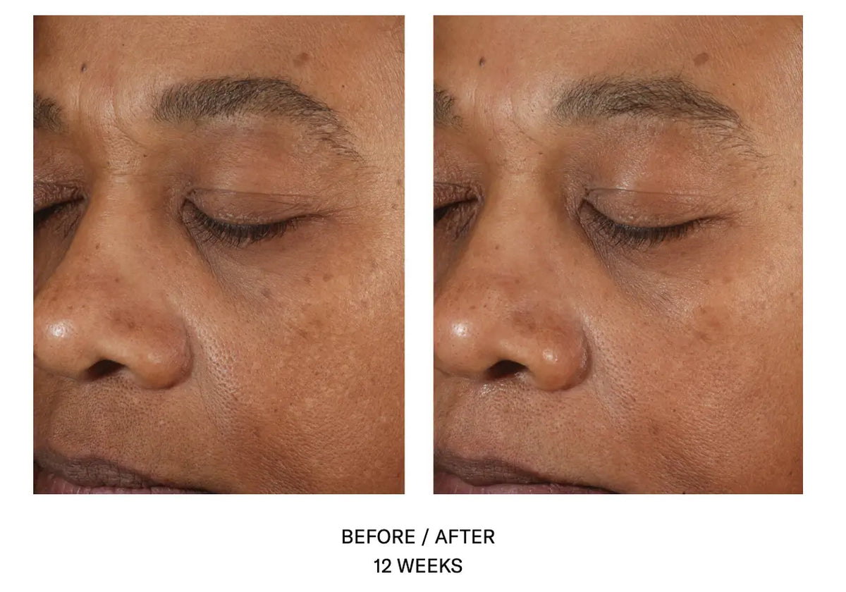 Before and After - A-Team Skinbetter