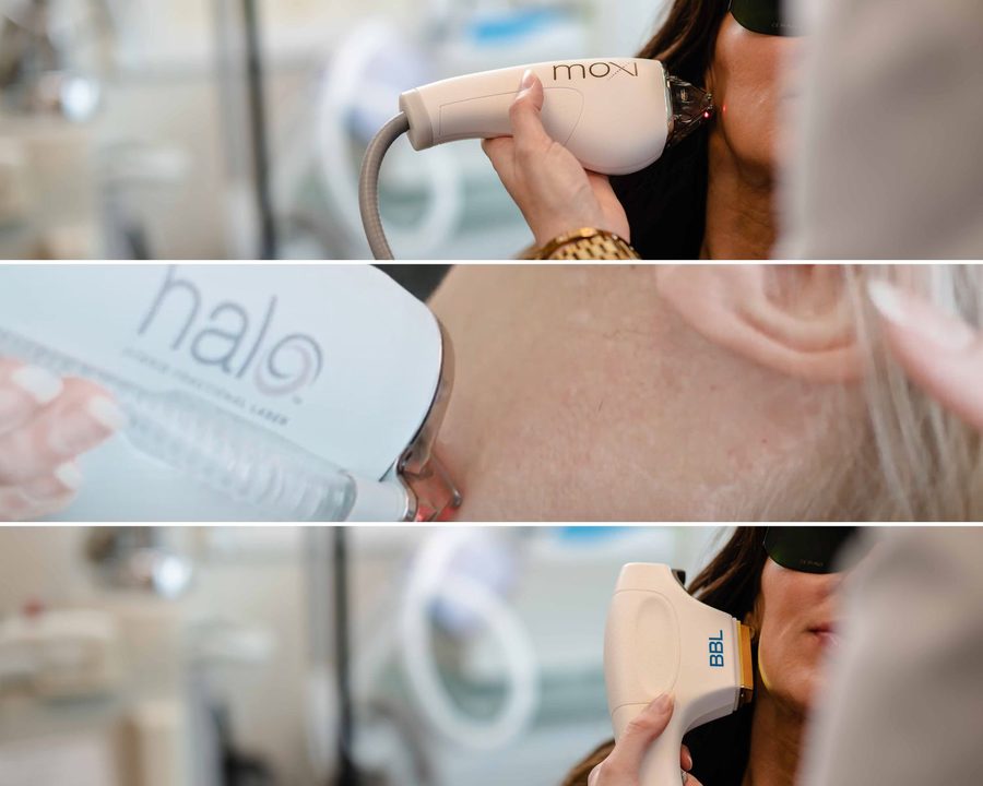 MOXI, HALO and BBL handpieces in use during laser treatments at The Piazza Center in Austin, Texas, with the patient in protective eye shields