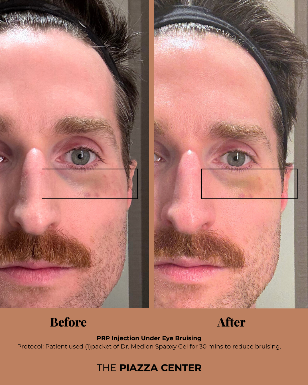 Patient Before and After after Dr. Medion Spaoxy Gel for Bruising 