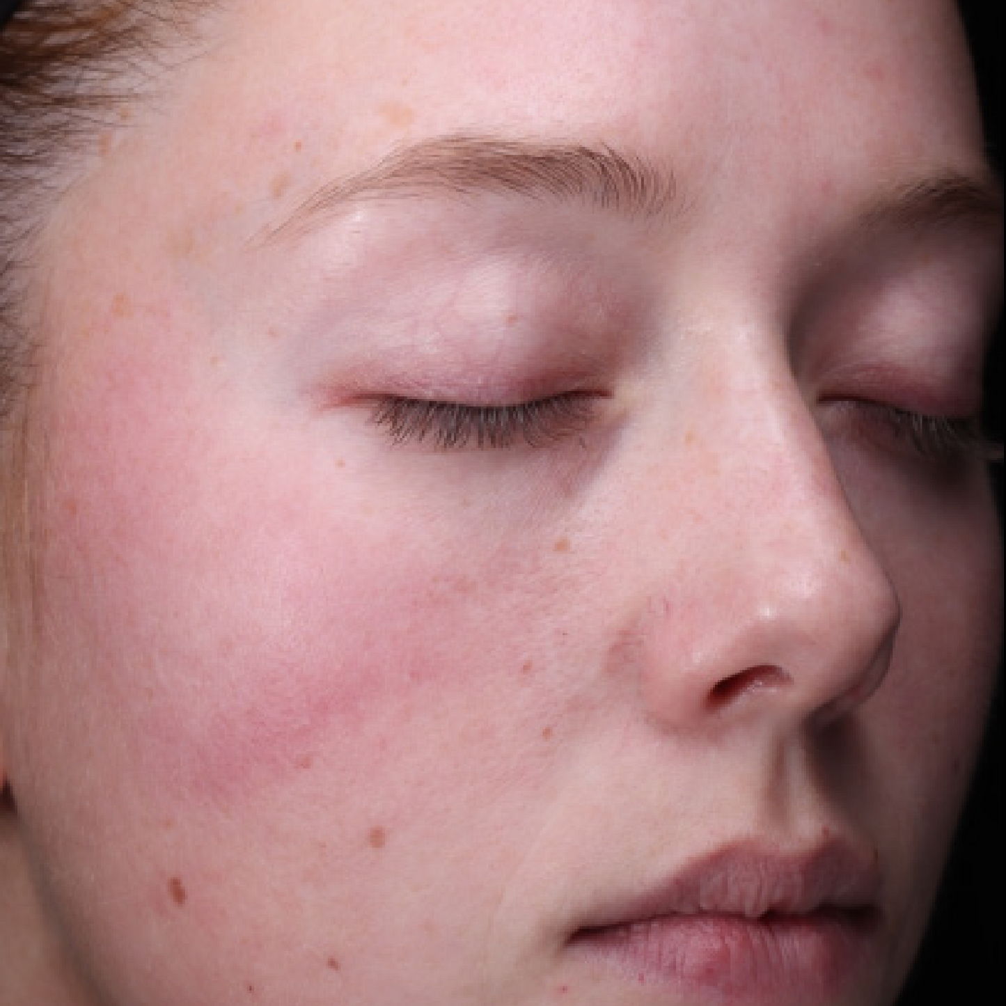 Before using Revision Radiance+ Resurfacing Serum — clinical photography supplied by Revision Skincare. Individual results may vary.