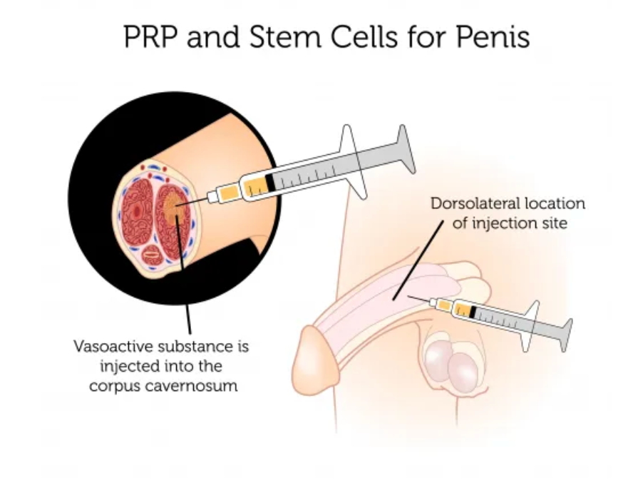 P-Shot For Men - Erectile Dysfunction Prevention (Call For Consultation)