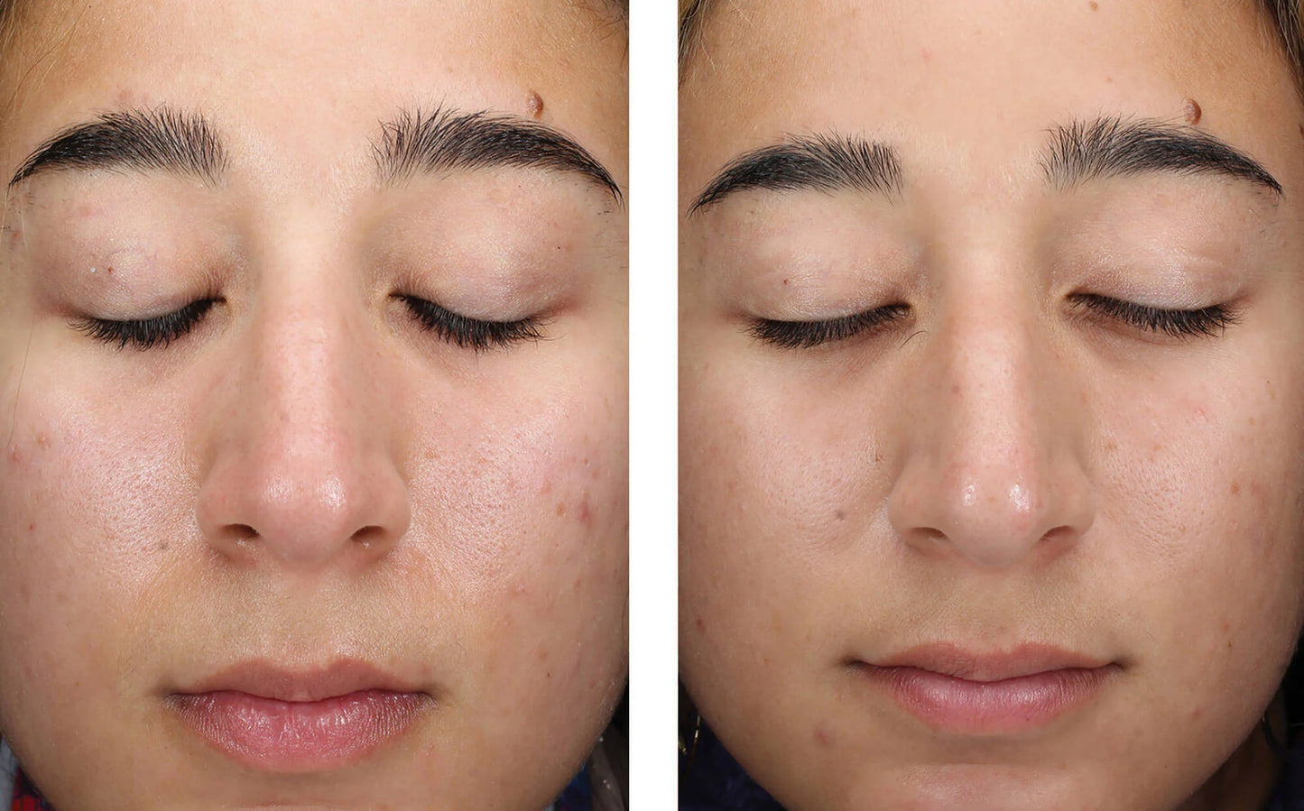 skinbetter clearing serum before and after female