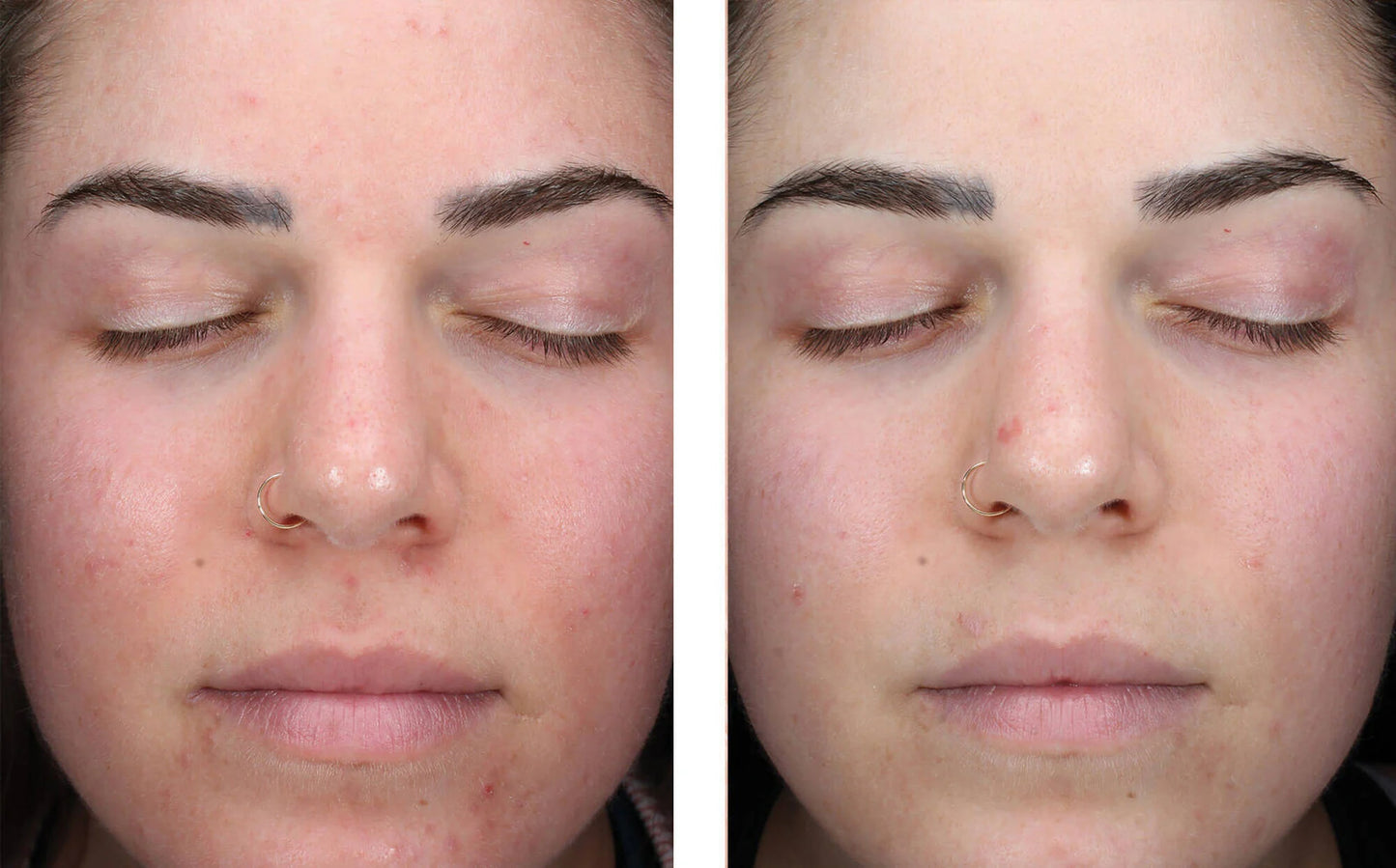 skinbetter clearing serum before and after female