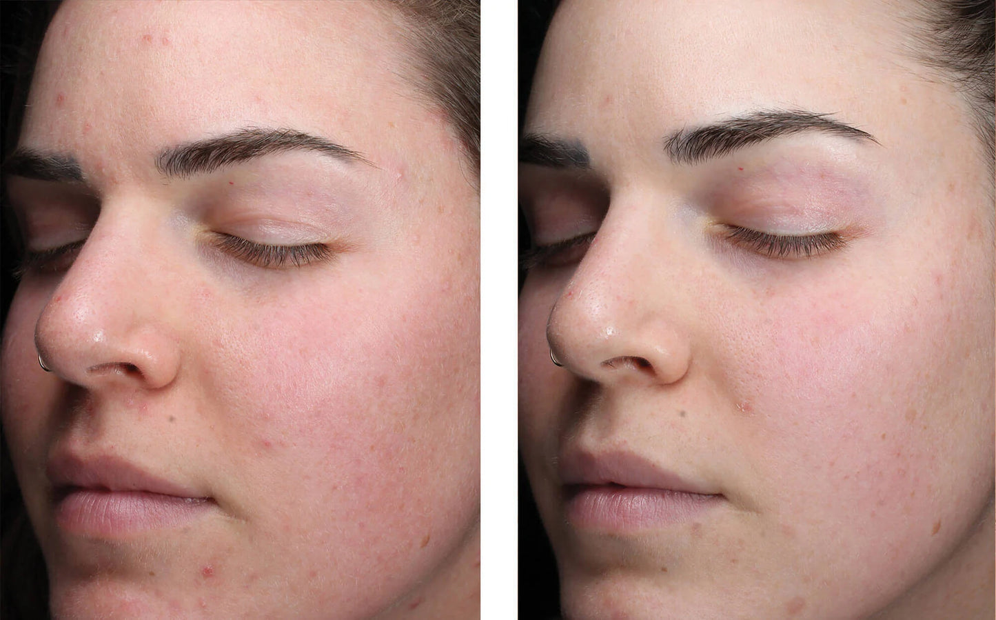 skinbetter clearing serum before and after female