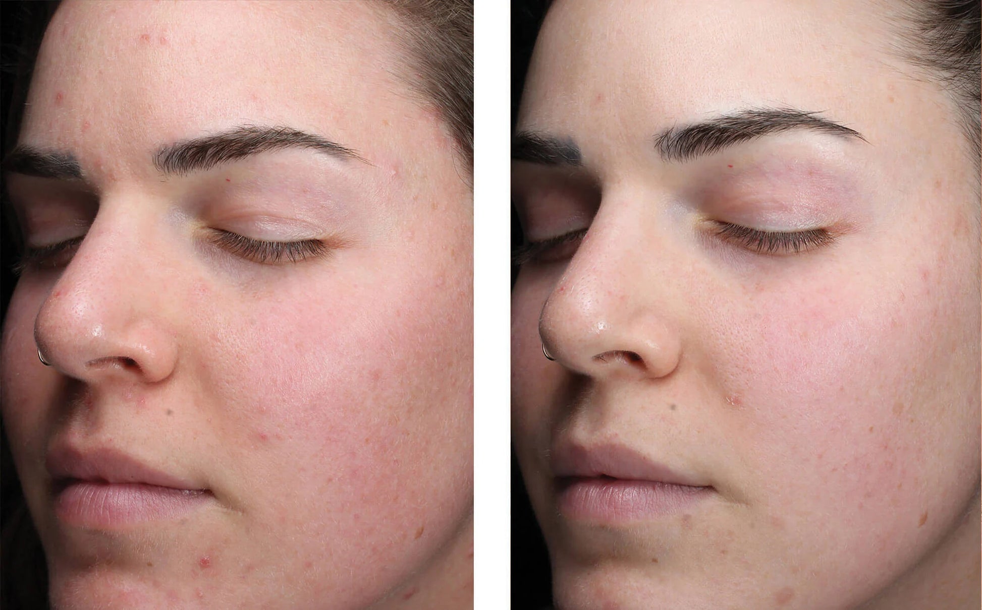 skinbetter clearing serum before and after female