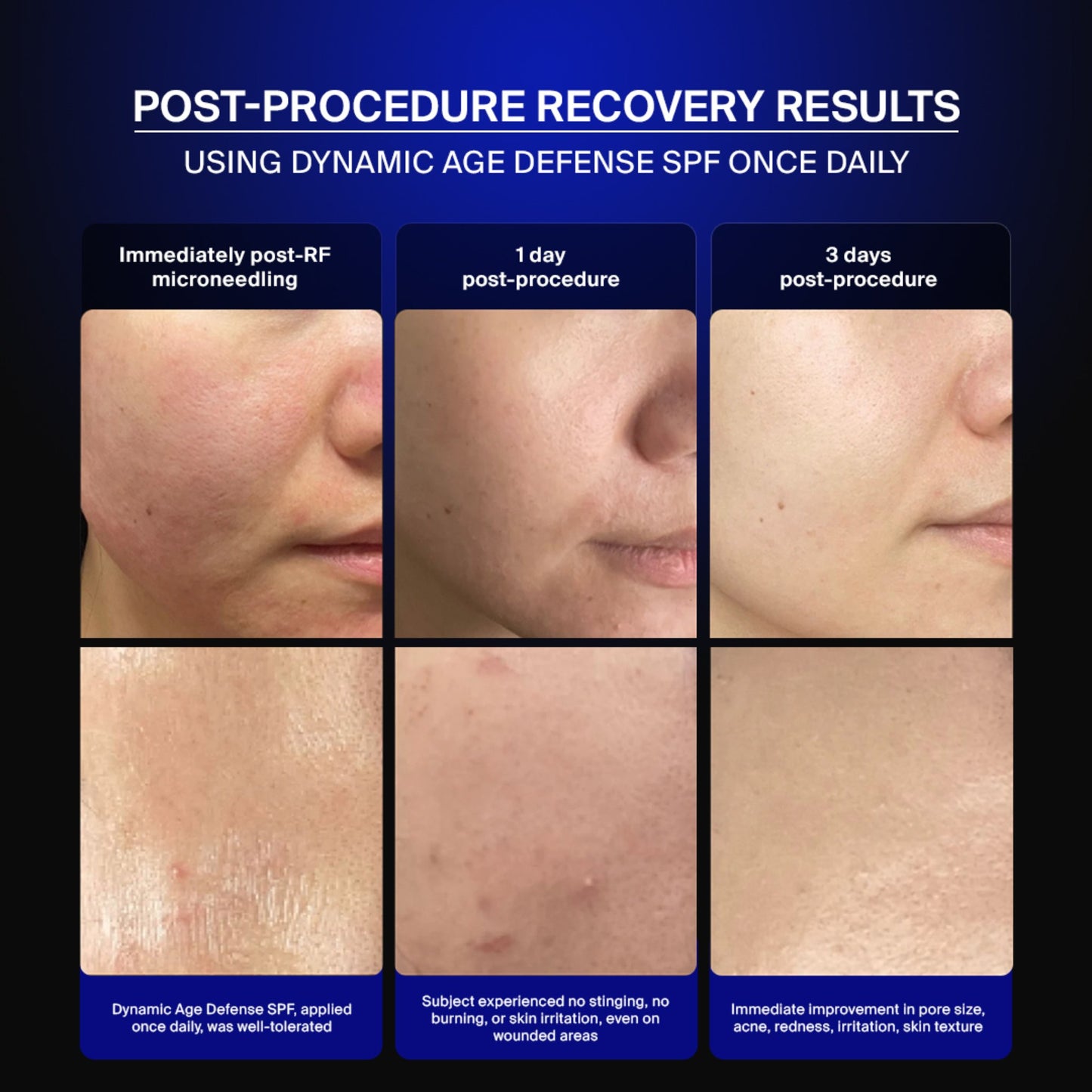 Pavise clinical photography: skin recovery after RF microneedling