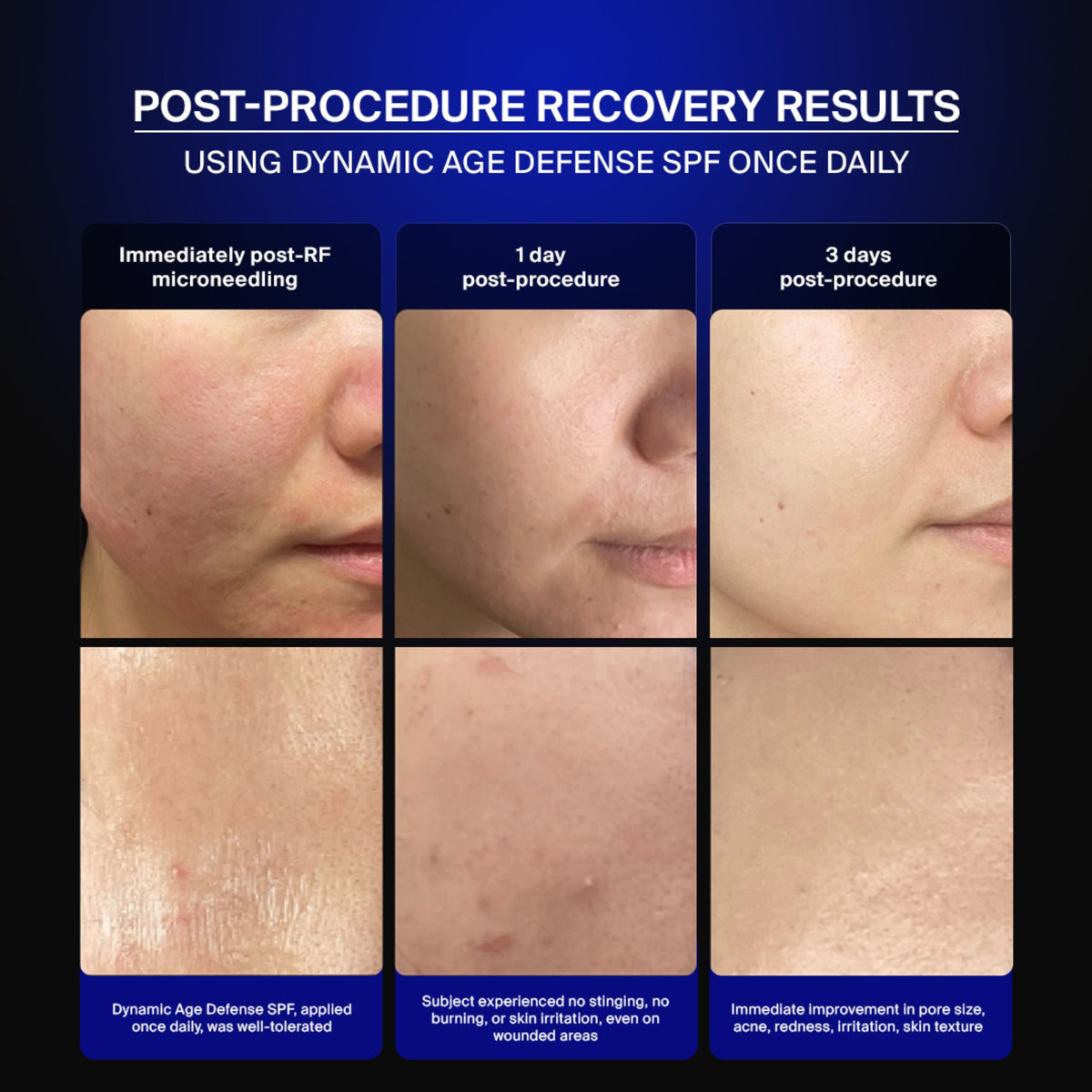 Pavise clinical photography: skin recovery after RF microneedling