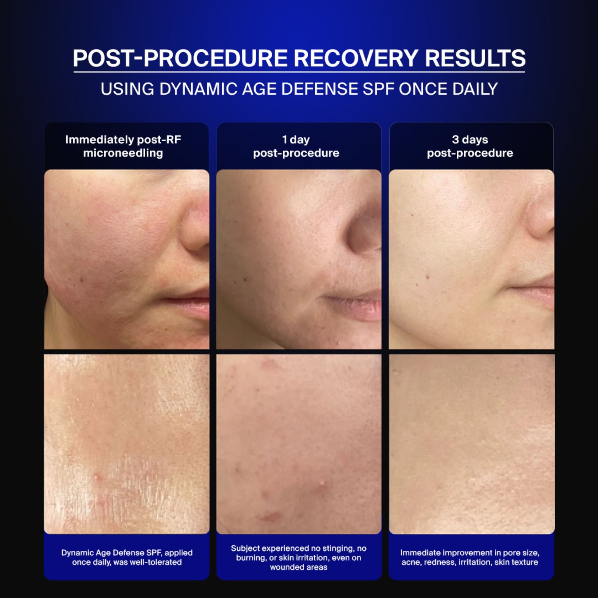 Pavise clinical photography: skin recovery after RF microneedling