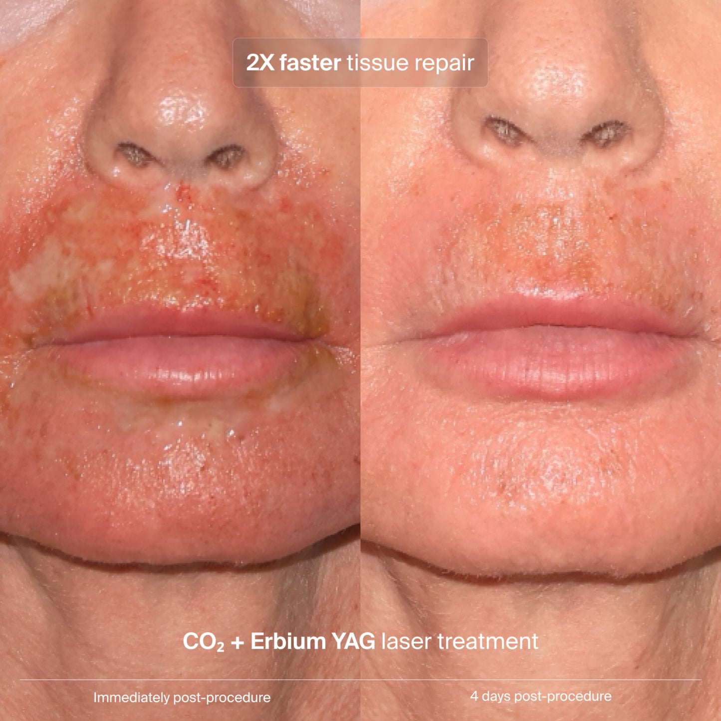 Pavise clinical data: 2X faster tissue repair after CO2 and Erbium YAG laser treatment
