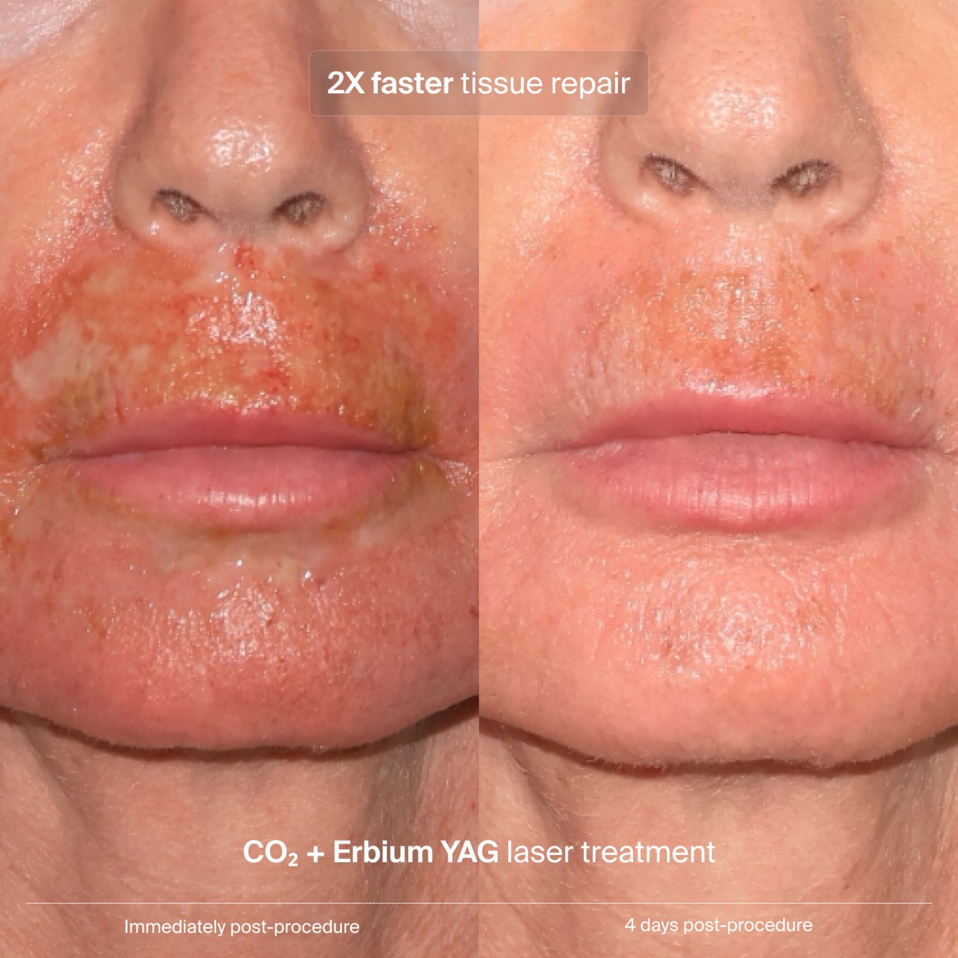 Pavise clinical data: 2X faster tissue repair after CO2 and Erbium YAG laser treatment