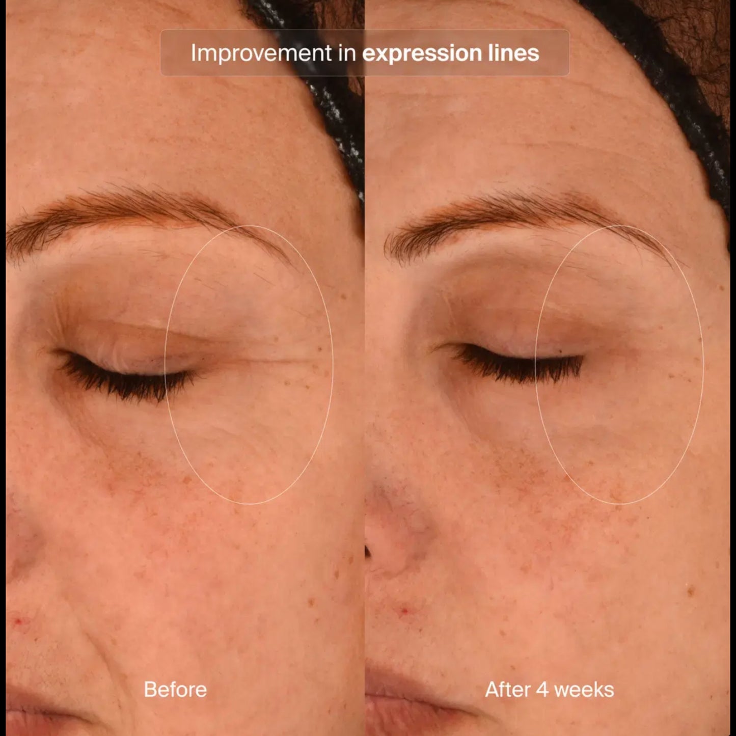 Pavise clinical photography: expression lines before and after 4 weeks