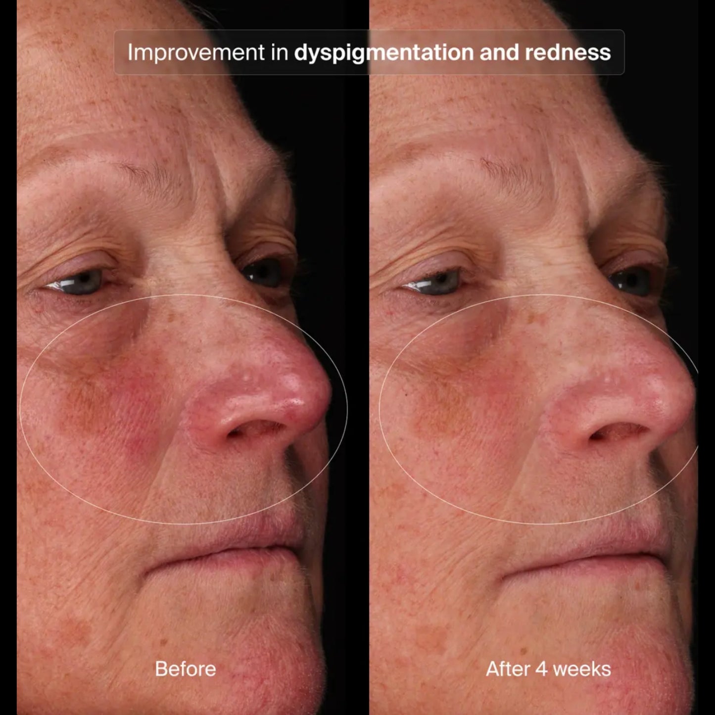 Pavise clinical photography: improvement in dyspigmentation and redness, before and after 4 weeks